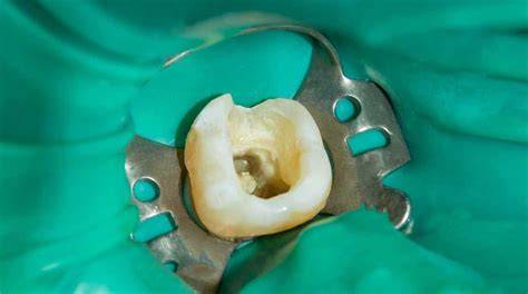 Aislamiento dental con dique de goma