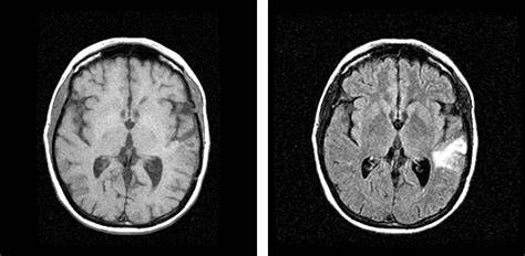 Resonancia magnética de lesión cerebral lingüística