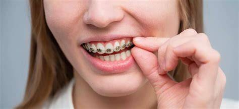 Frenillos cerámicos blancos sobre dientes
