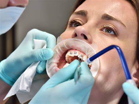 Instalación de brackets cerámicos paso a paso