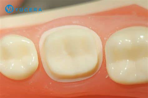 Preparación dental para coronas parciales cerámicas