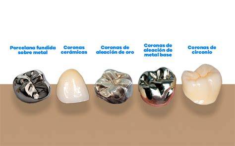 Coronas parciales cerámicas cementadas definitivamente
