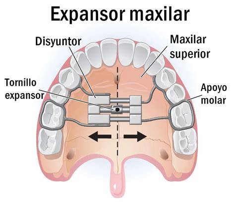 espacio entre incisivos durante expansión dental
