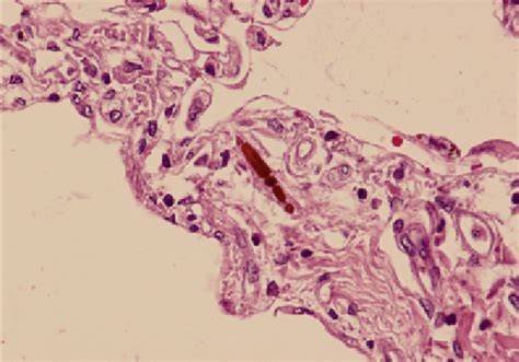 Cuerpo de asbesto en tejido pulmonar