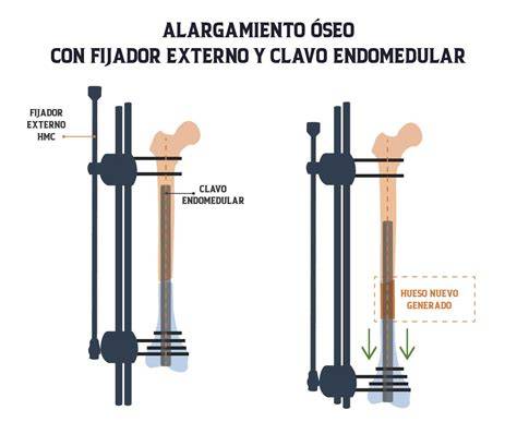 Fijador externo para alargamiento óseo