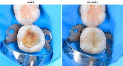 Aislamiento de tejidos con vaselina y acrílico dental